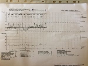 Если во время ктг ребенок не шевелится