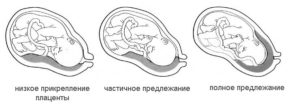 Плацента низко расположена что это значит при беременности