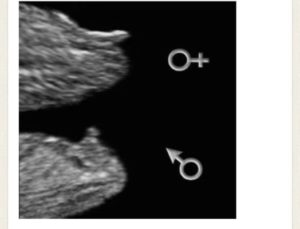 Определение пола ребенка в 13 недель по узи