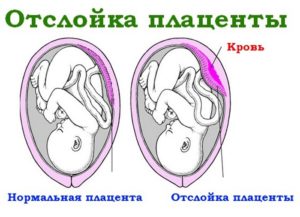 Как проявляется отслойка плаценты во втором триместре