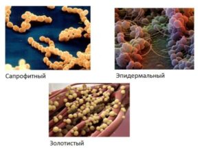 Сапрофитный стафилококк при беременности