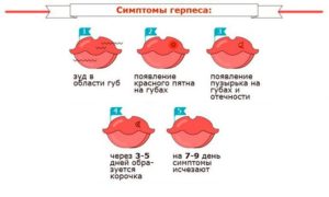 Простуда при беременности на ранних сроках на губах