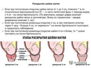 Сколько должно быть раскрытие шейки матки для родов