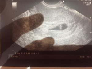 Гипертонус задней стенки матки при беременности 13 недель