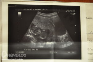 Гипертонус по задней стенке матки при беременности форум