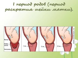 Раскрытие шейки 4 см