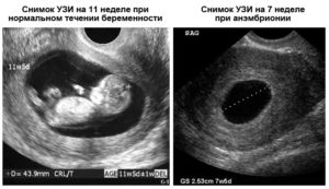 На какой неделе беременности эмбрион виден на узи