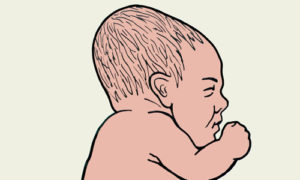 Форма головы у новорожденных долихоцефалическая