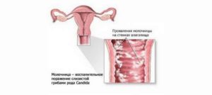 Молочница влияет на беременность