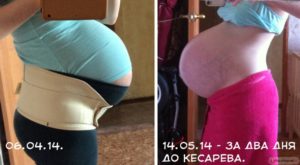 Живот при многоплодной беременности