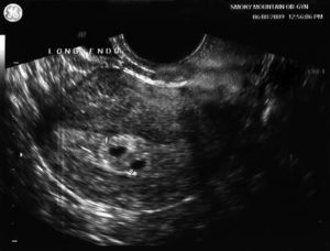 4 недели беременности двойня