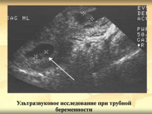 На какой день узи покажет беременность после зачатия