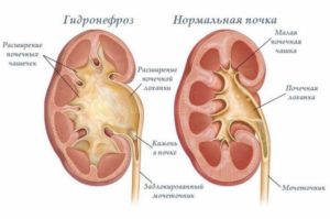 При беременности расширение лоханки