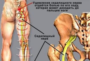 Воспаление седалищного нерва при беременности симптомы и лечение