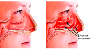 Заложенность носа без насморка лечение при беременности
