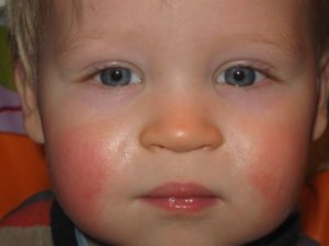 Почему у ребенка щеки красные