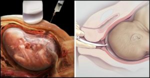 Прокол матки при беременности