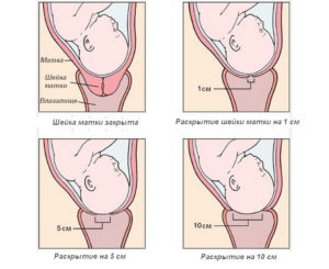 Мягкая шейка когда роды