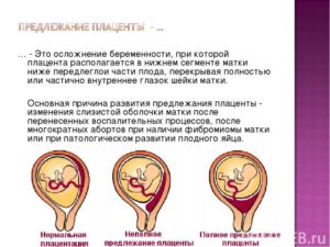 Предлежание плаценты 20 недель