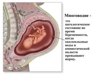 В 38 недель многоводие