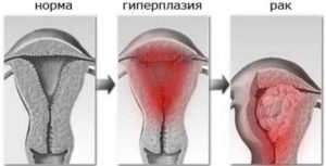 При климаксе разрастание эндометрия