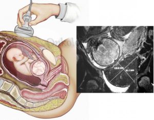 Матка маленькая во время беременности