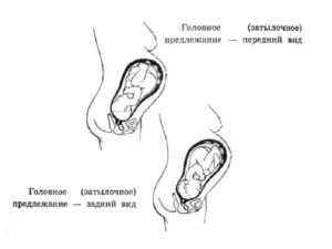 Головное предлежание плода 1 позиция передний вид