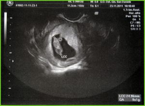 На 5 неделе беременности как выглядит на узи