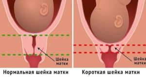 Короткая шейка матки после родов