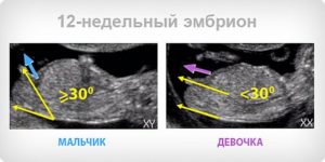 Определение пола ребенка в 12 недель