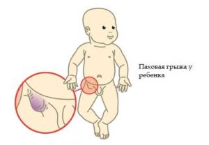 Грыжа у ребенка в паху