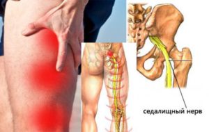 Воспаление седалищного нерва при беременности симптомы и лечение