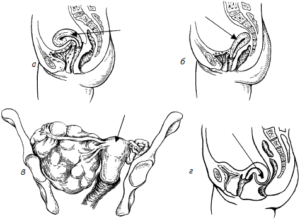 Смещение матки при беременности