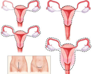 Климакс при удалении матки