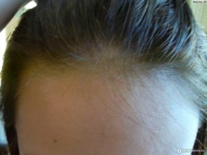 Из за какого гормона выпадают волосы у женщин