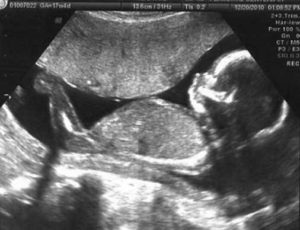 Пол ребенка на 18 неделе беременности узи