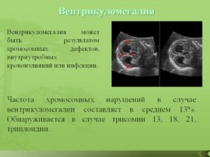 Вентрикуломегалия лечение у плода