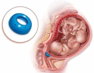 Для чего нужен акушерский пессарий