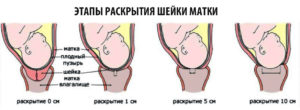 Открытие шейки матки на 4 см когда рожать