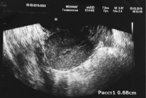 Остатки плацентарной ткани после родов