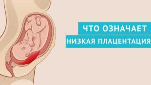 20 недель низкая плацентация