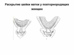 Раскрытие шейки у повторнородящих