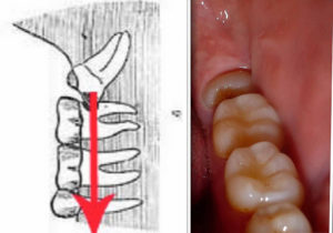 Зуб мудрости не может прорезаться