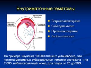 Ретрохориальная гематома в стадии организации при беременности