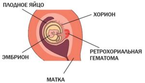 Ретрооболочечная гематома при беременности