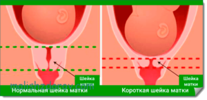 Короткая но закрытая шейка матки