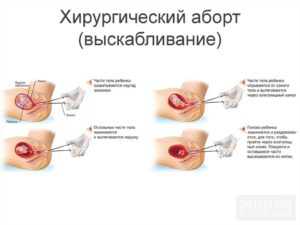 Когда после выскабливания можно забеременеть