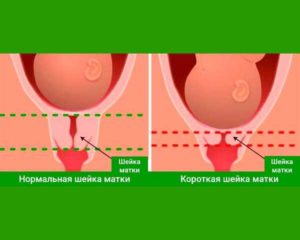 Матка при наступлении беременности