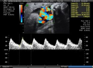 Узи при беременности кровотока