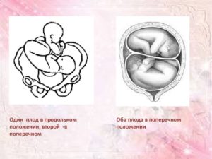 Позиция плода при поперечном положении определяется по расположению